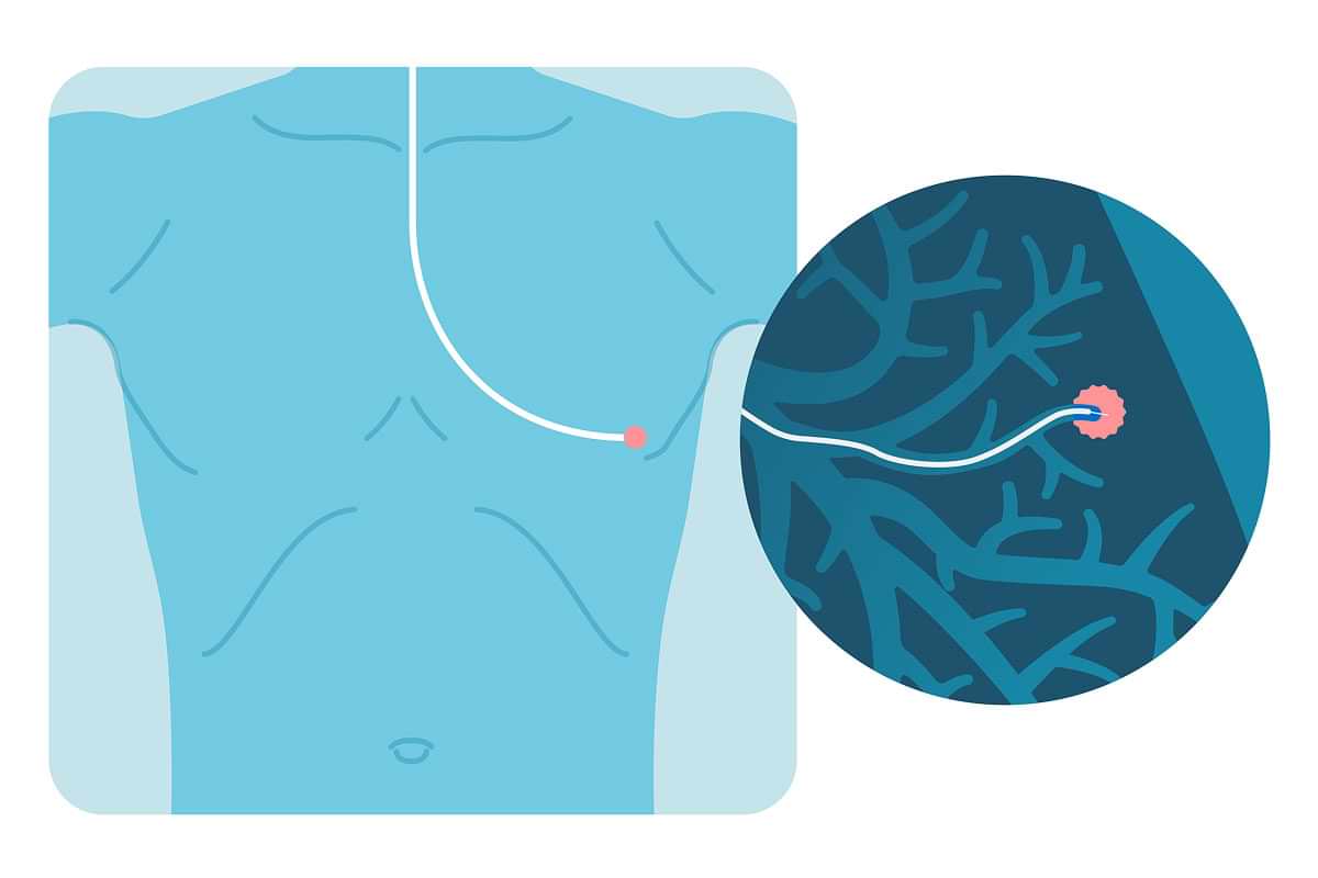 An image of ion robotic-assisted bronchoscopy illustration