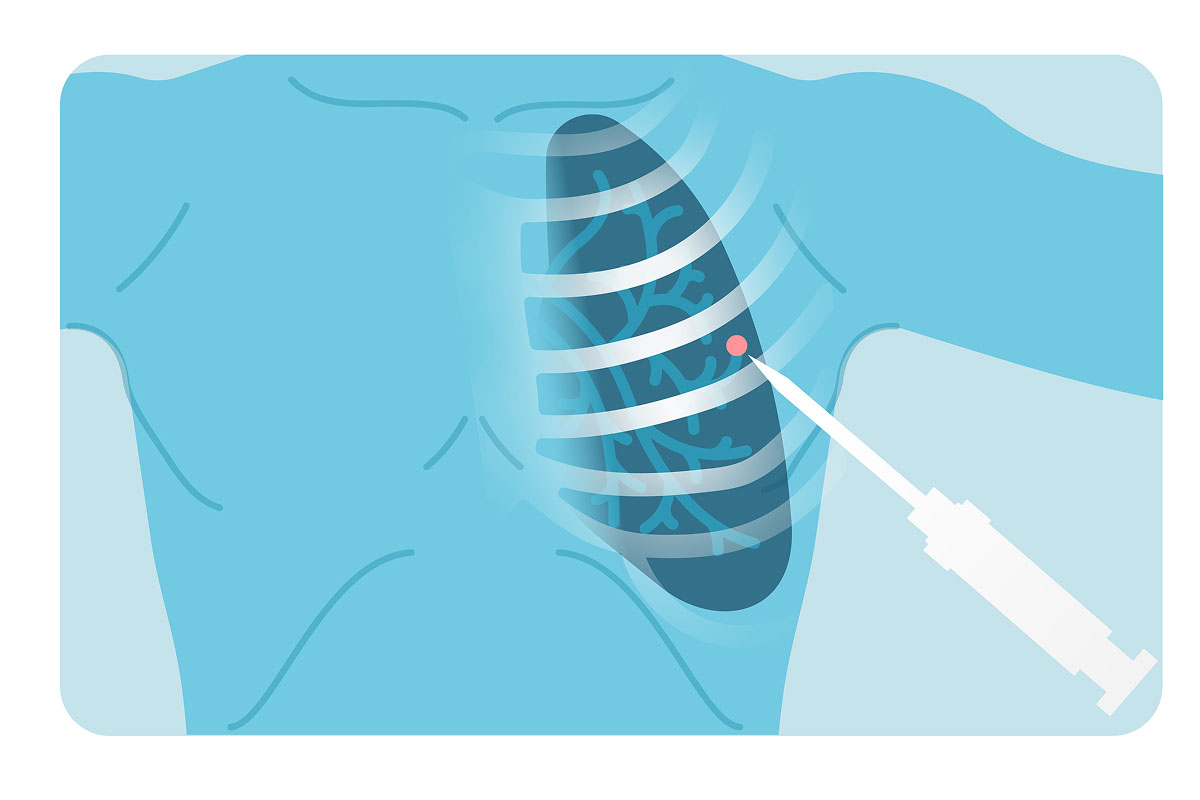 An image of transthoracic needle biopsy illustration