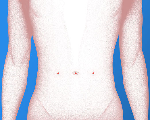 Minimally invasive incision