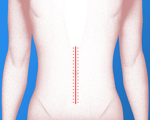 Traditional (Open) surgery incision