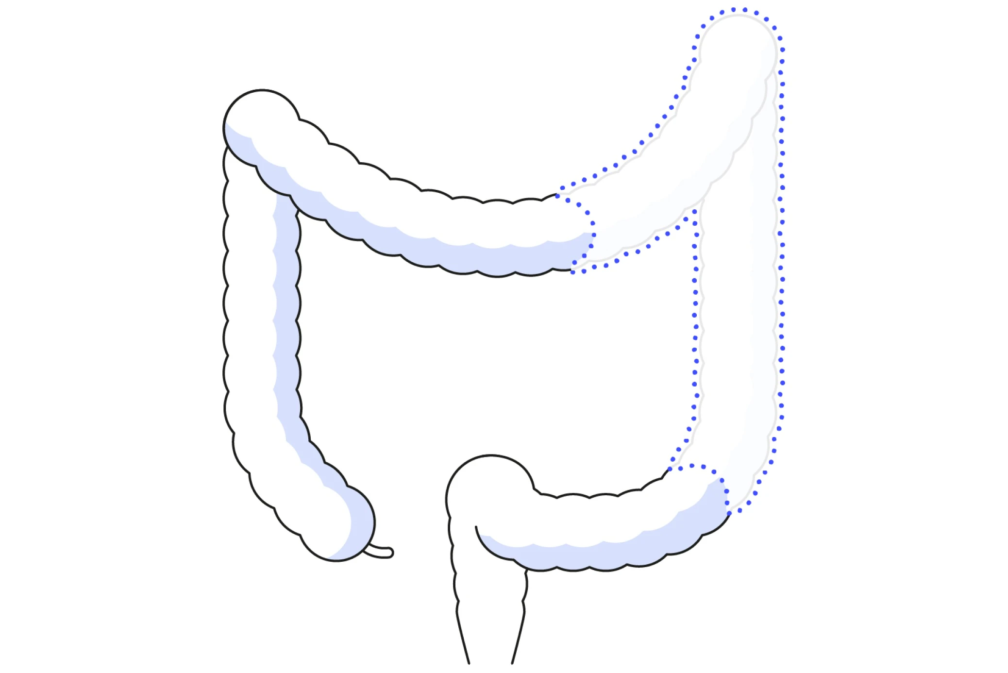 Robotic instruments removing the diseased section of the colon