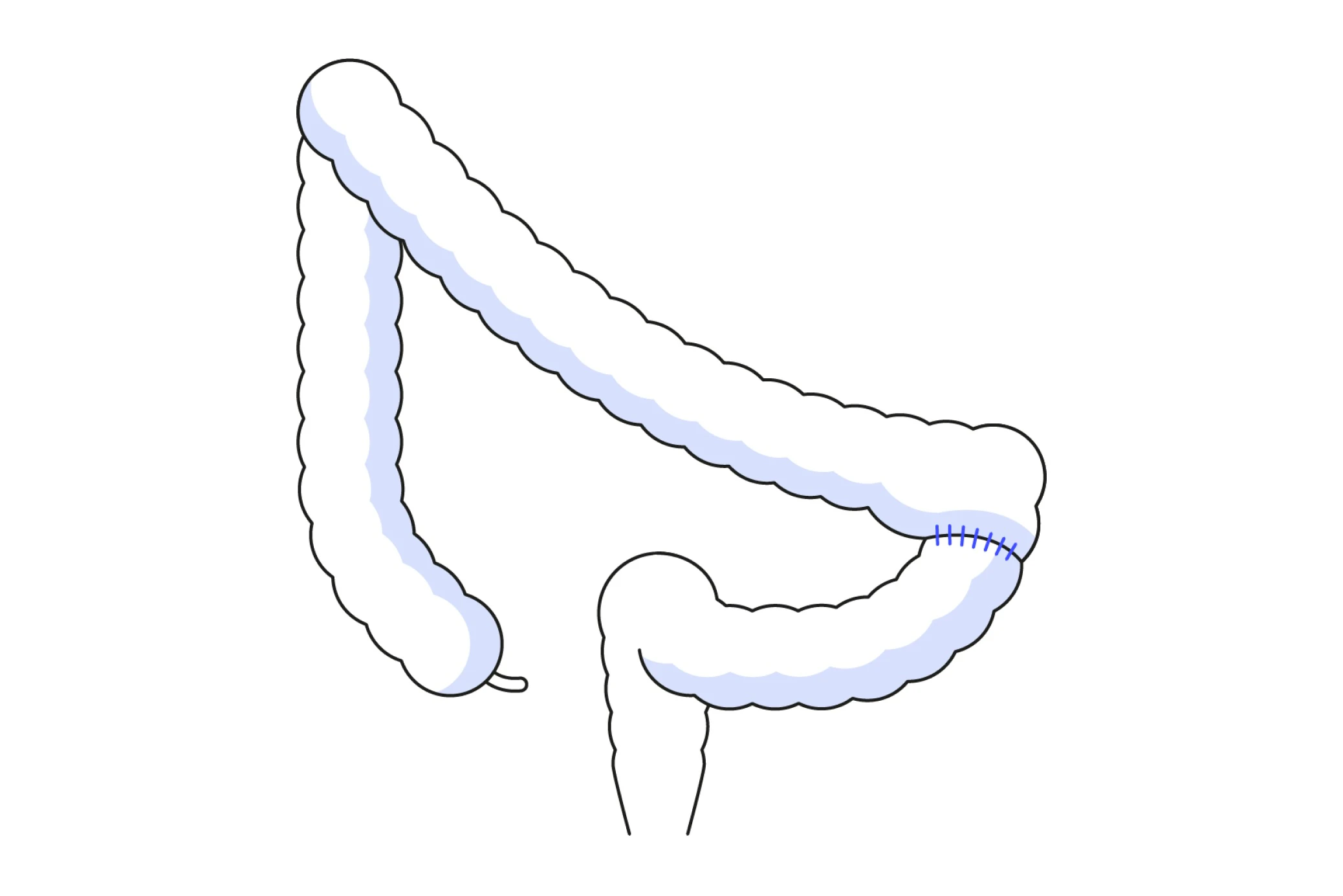 Reconnecting healthy colon sections using da Vinci instruments