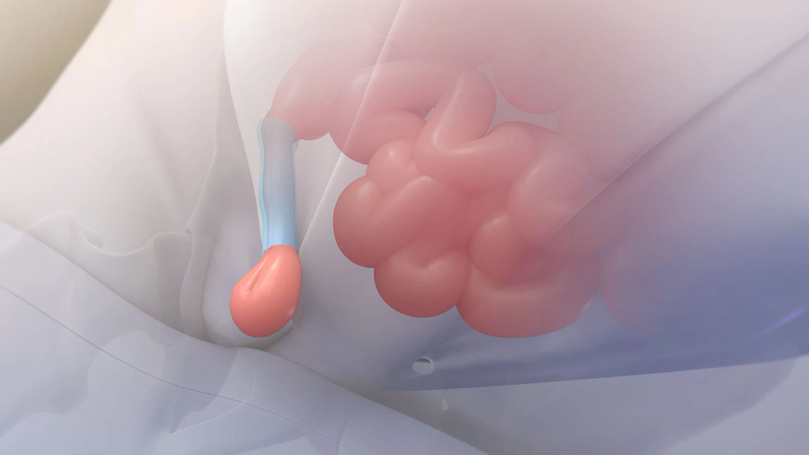 Inguinal hernia repair surgery illustration